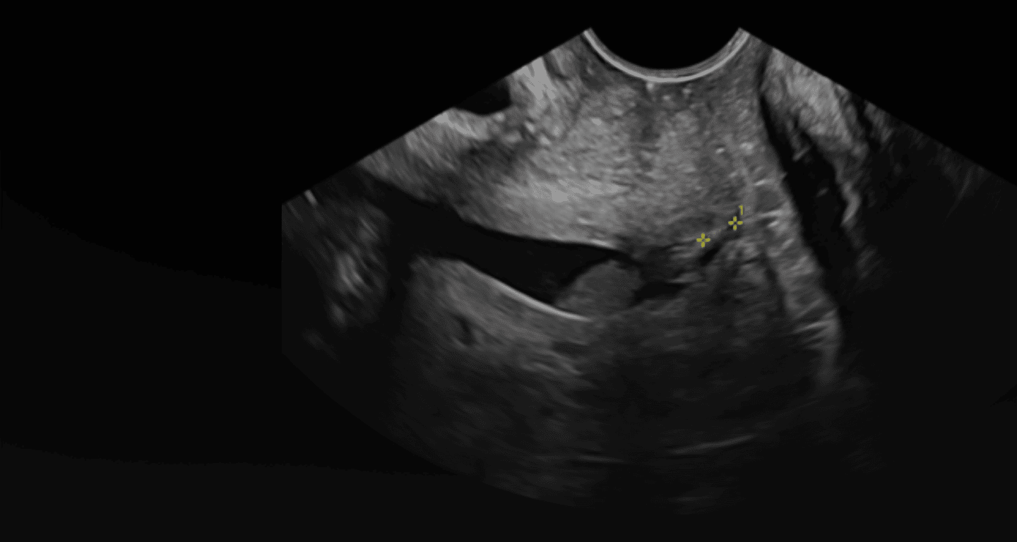 “At Your Cervix”: Screening & Treatment of a Shortened Cervix during Pregnancy