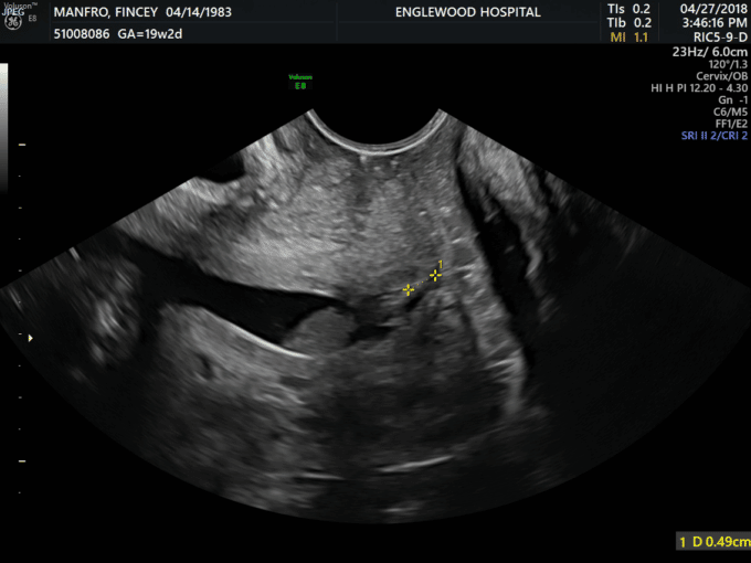 "At Your Cervix" Screening & Treatment of a Shortened Cervix during